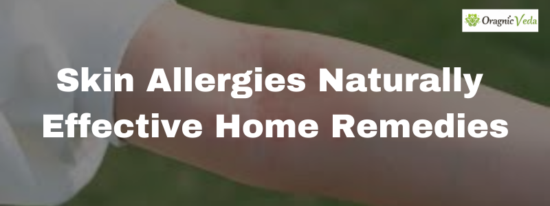 Skin Allergies, Home Remedies